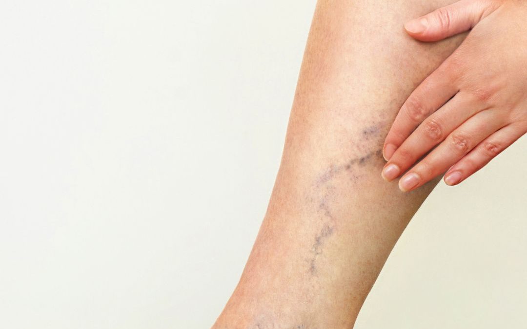 What Causes Varicose Veins and How to Get Rid of Them