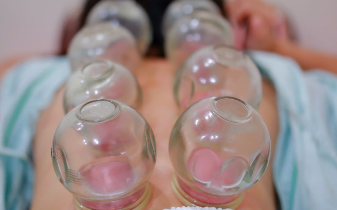 Have You Been Cupped Before?