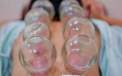 Have You Been Cupped Before?