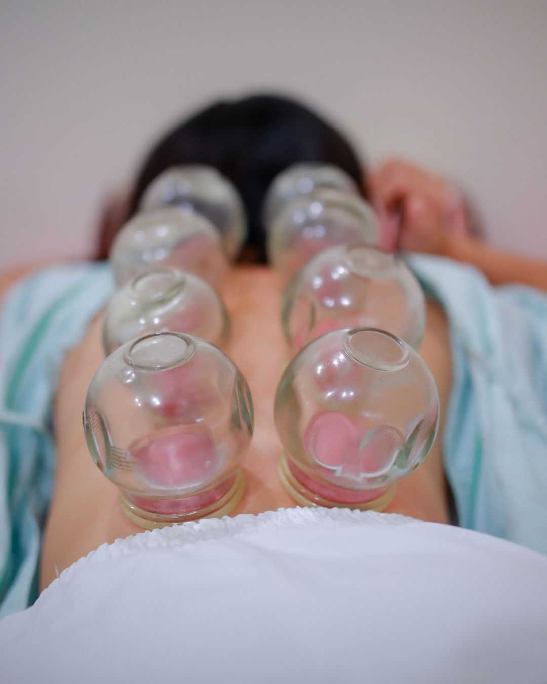 Have You Been Cupped Before?