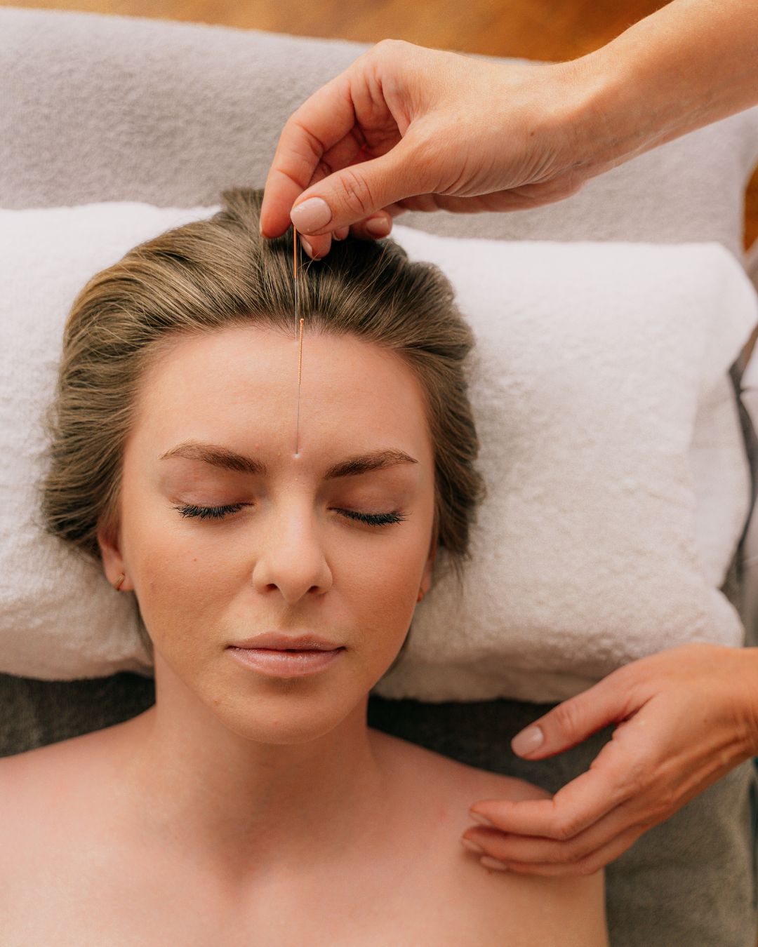 Facial Rejuvenation Acupuncture (1)